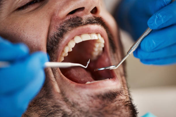 Best Emergency Wisdom Tooth Extraction in Brookneal, VA